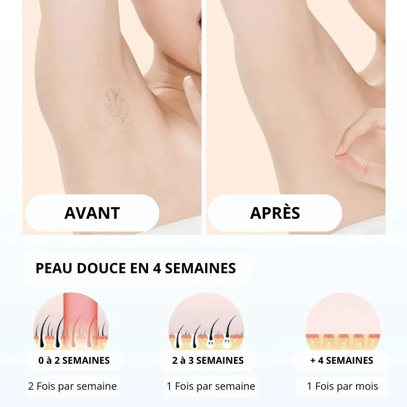 Épilateur Laser - IPL