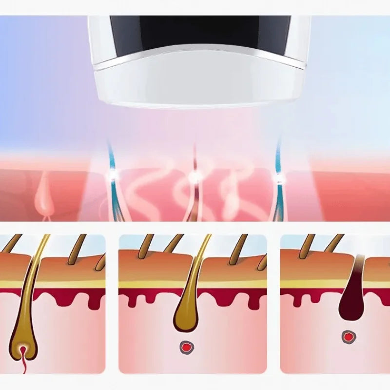 Épilateur Laser Portable Efficacité Redoutable